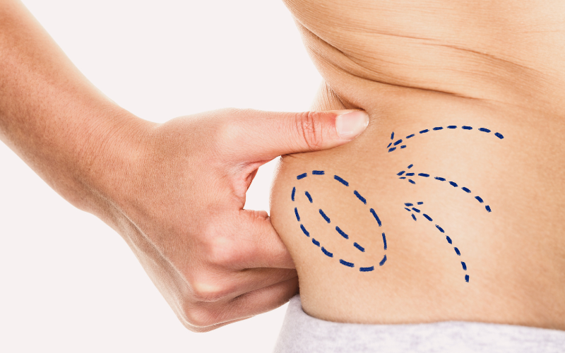 Liposuction vs Tummy Tuck – Which One Is Right for You?