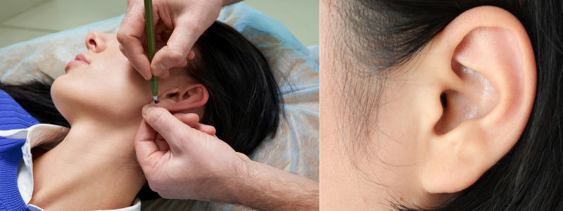 Prominent ear correction